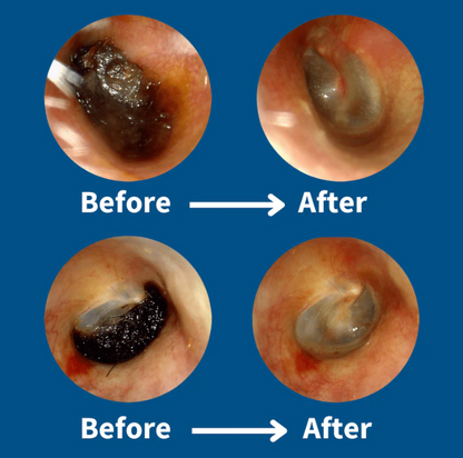 CleanEar Pro™ Earwax Removal Kit